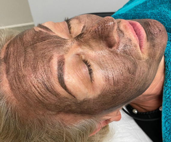 Laser Carbon Facial