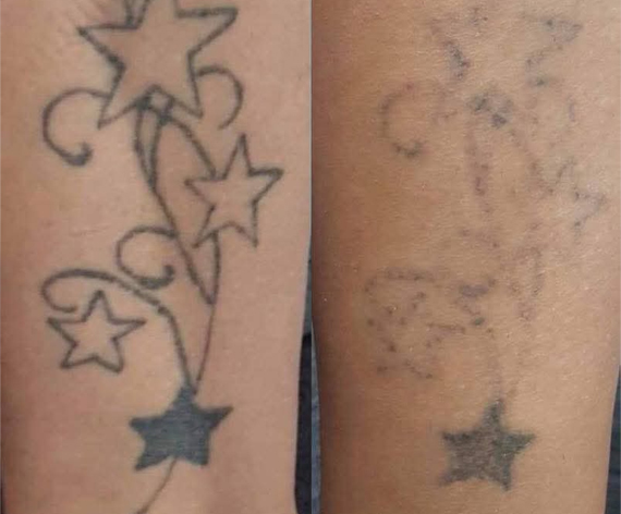 Laser Tattoo Removal & Lightning