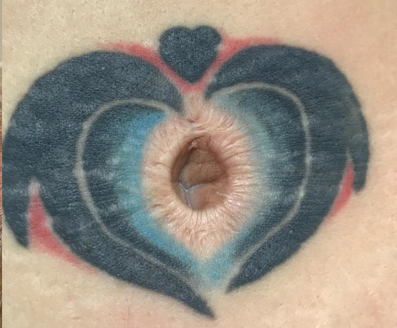 Tattoo Removal Courses